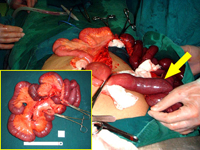 Perforated intestine causes severe abdominal pain