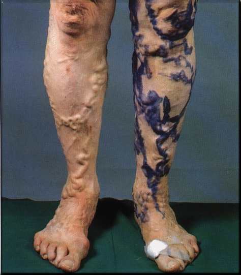 Varicose veins in both legs